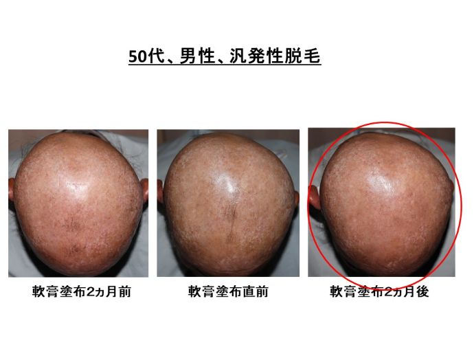 円形脱毛症　病院